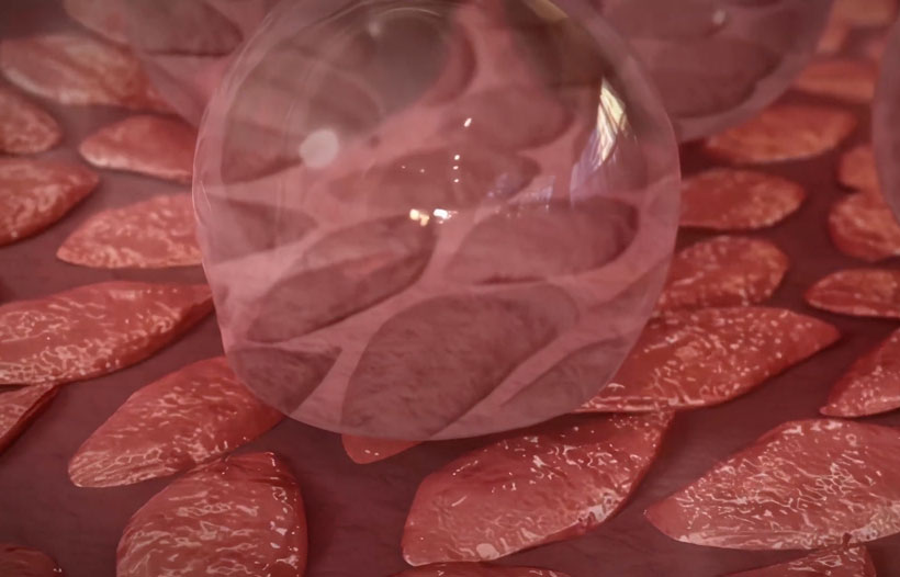 VenaSeal Closure System for Superficial Vein Therapies  | Video