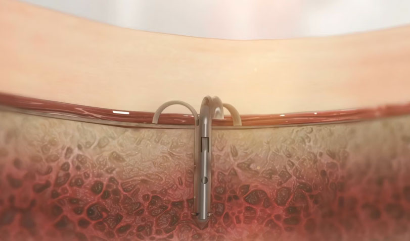 Zift Medical ZiftLift® Transforming Brow Lifts | Cosmetic Animation 2015