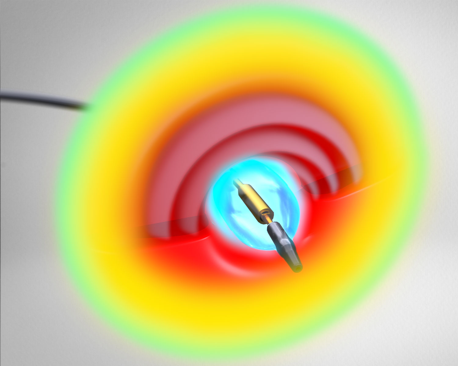  Recor Medical's Paradise Renal Denervation System