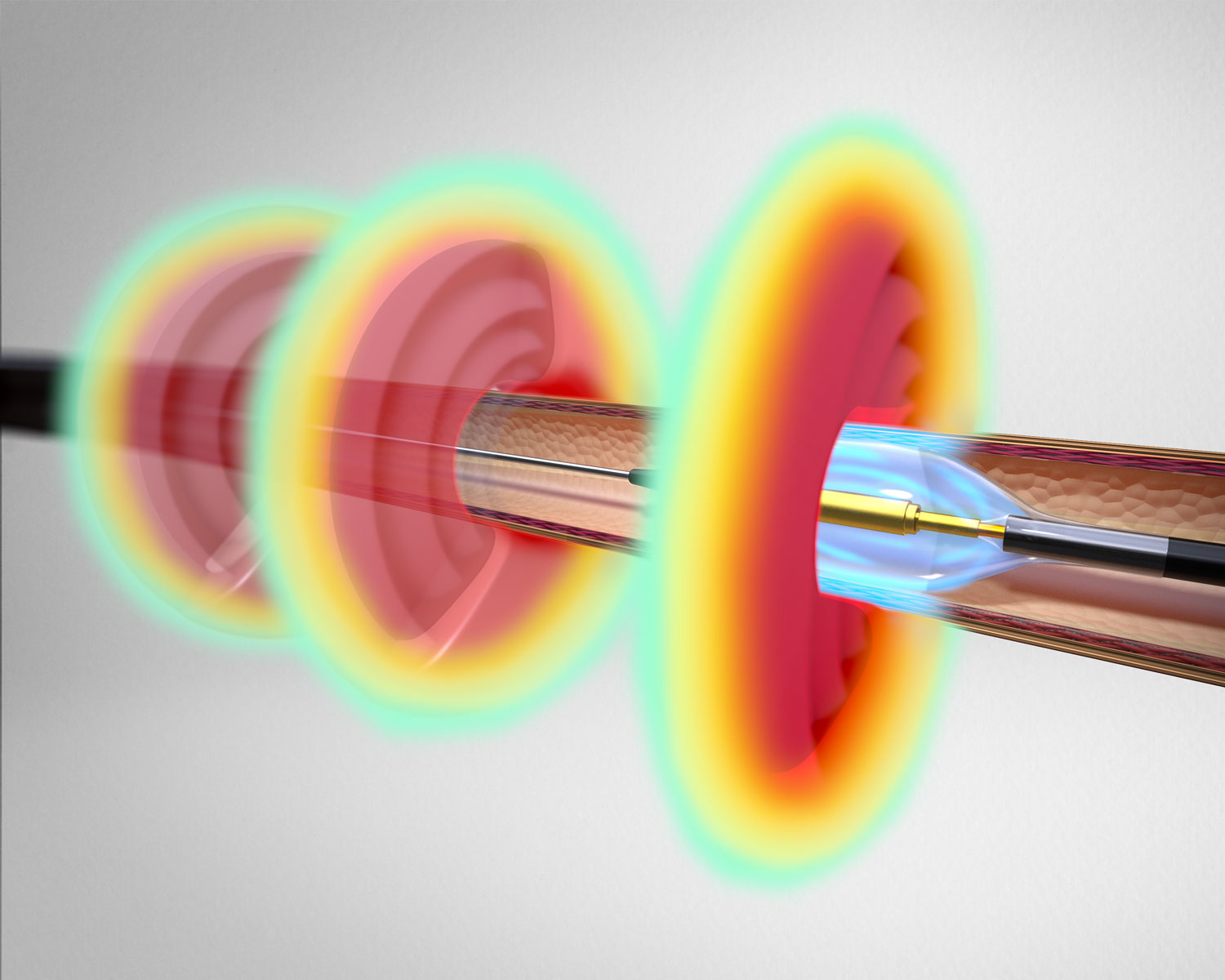 Recor Medical's Paradise Renal Denervation System showcases the innovative approach to treating hypertension and reducing blood pressure.