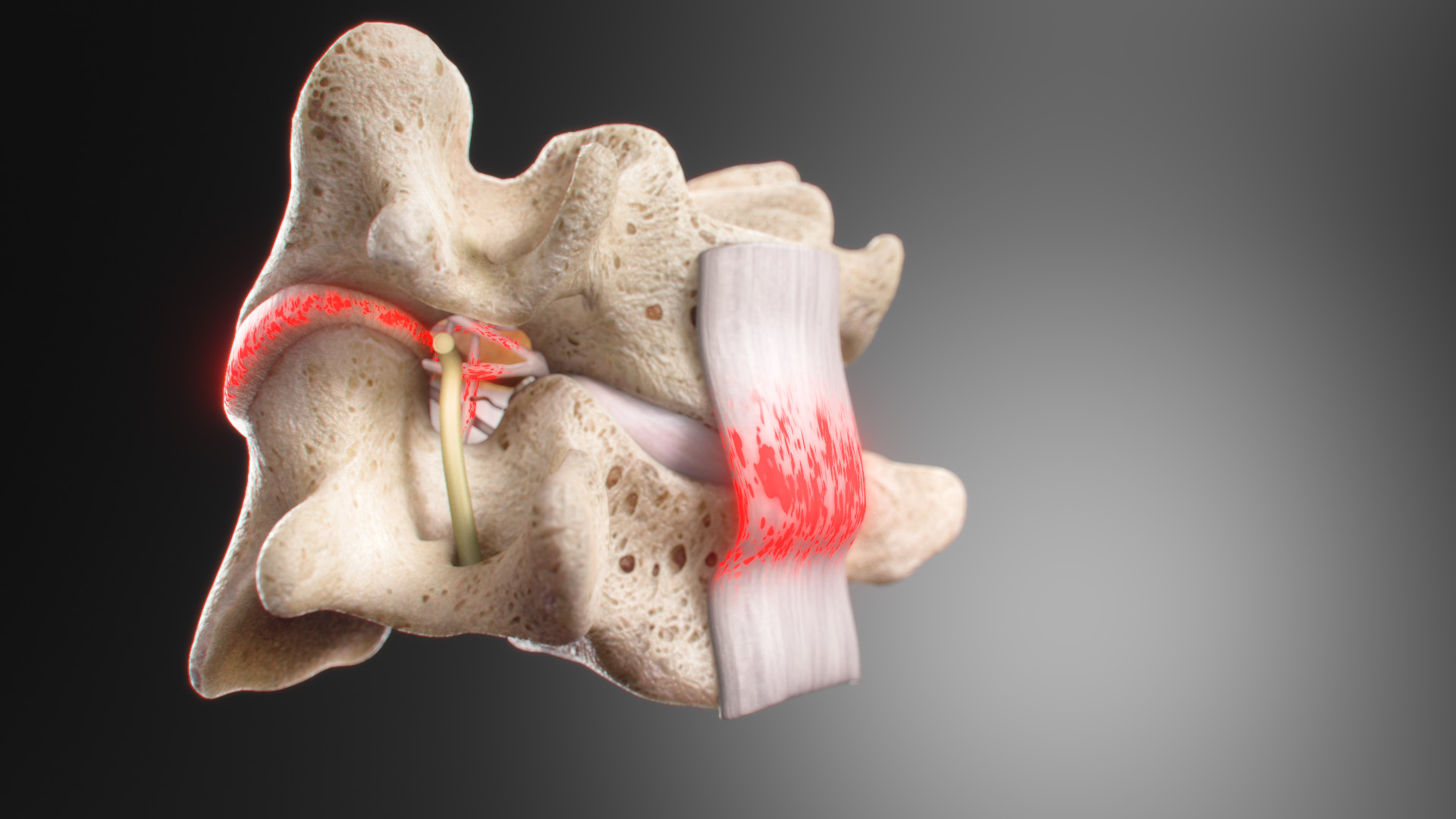 severe angular injury to the spine. The nerve compression caused by the swelling of damaged spinal support ligaments is a crucial aspect depicted in the illustration. 