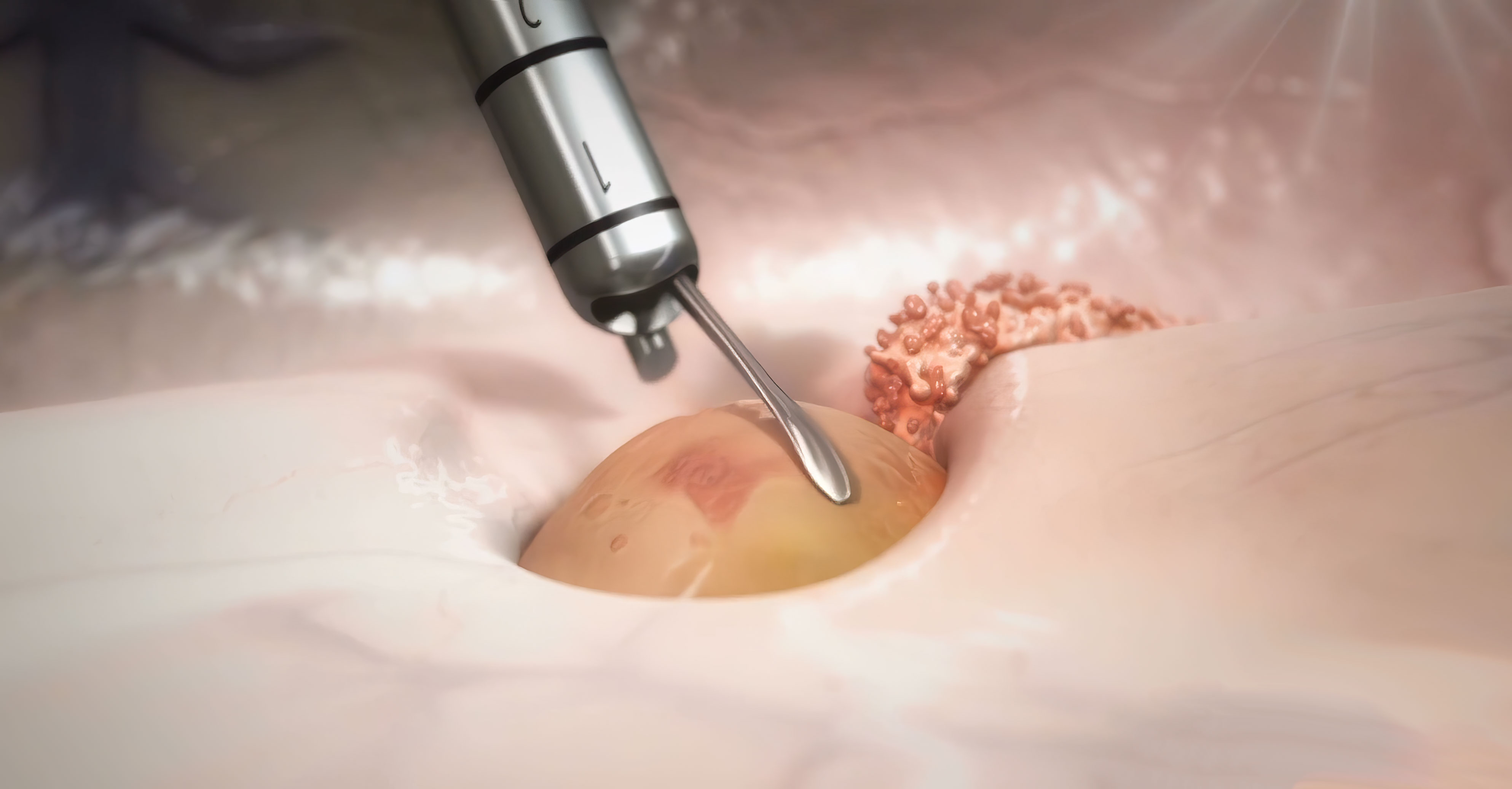 Medical illustration of the Minop InVent Device, a respiratory health device. The device is advanced and helps with breathing difficulties. Improve your respiratory health with the Minop InVent Device.