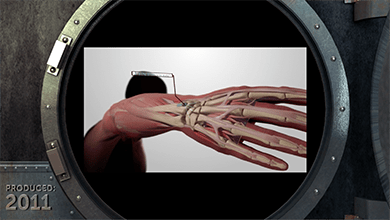 Total Coverage, medical animation, comprehensive coverage, traumatic injuries, anatomical model, implantation process, orthopedic medicine, trauma surgery, benefits.