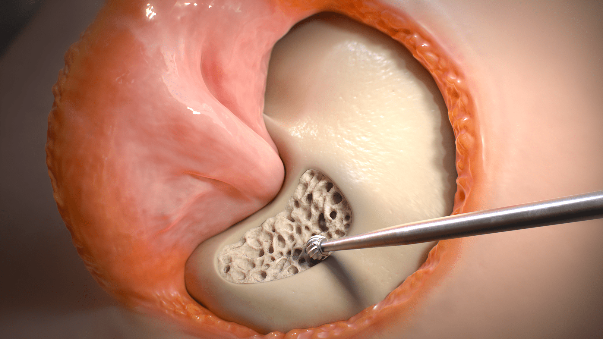 Transpetrosal Approach, surgical technique, Baylor Scott & White Health, Petroclival Meningioma, slow-growing noncancerous tumor, skull base, neurological impairments, headaches, hearing loss, double vision, facial pain, numbness, dizziness, facial weakness, coordination loss, surgery, tumor growth, neurosurgery, innovative surgical technique, noncancerous tumors, relief, medical specialties, neurology, neurosurgery, oncology, radiology, otolaryngology, ophthalmology, neuro-ophthalmology.
